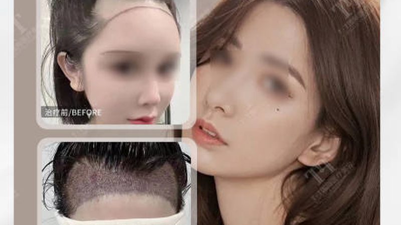 双眼皮修复，揭秘恢复自然的时间之谜