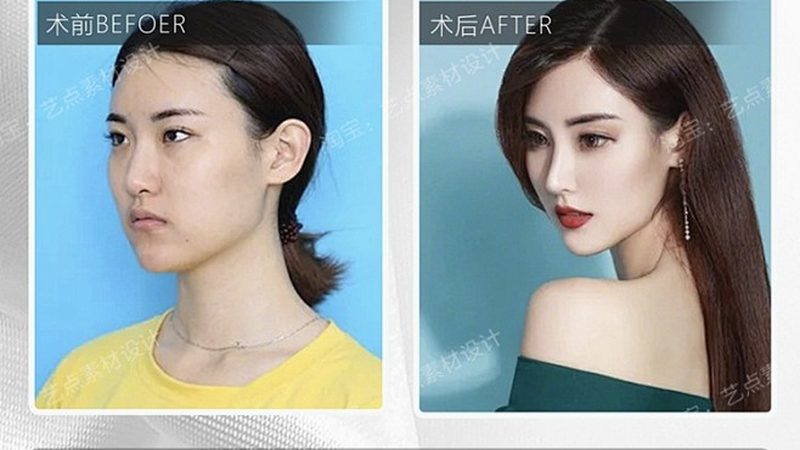 隆鼻前先搞懂“资质”比看案例更重要