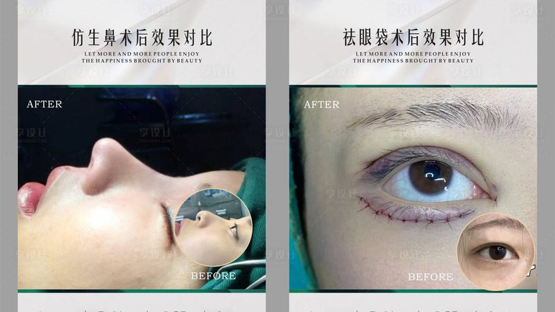 光子嫩肤后反黑，代谢周期到底要多久