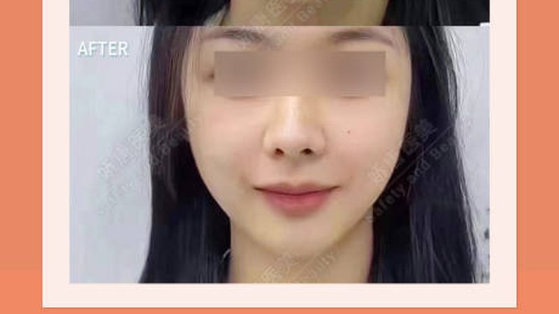 轻医美与微整形，揭秘操作流程背后的秘密
