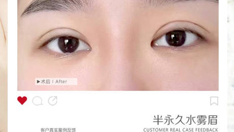 热玛吉设备选型：别被“厂家”二字带偏了