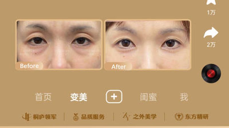 30岁，热玛吉还是线雕？揭秘两种美容项目的奥秘**